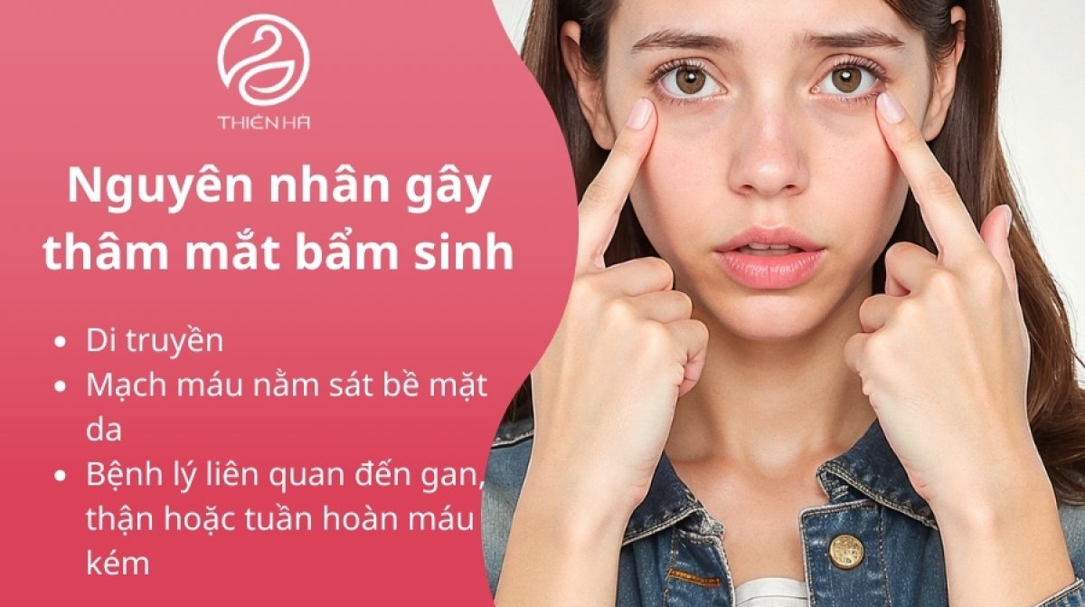 Thâm mắt bẩm sinh: Nguyên nhân, cách chữa 