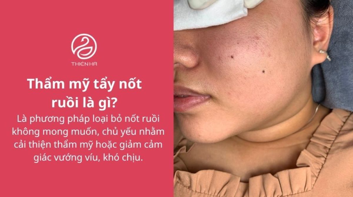 Thẩm mỹ tẩy nốt ruồi: Phương pháp, chi phí và lưu ý an toàn