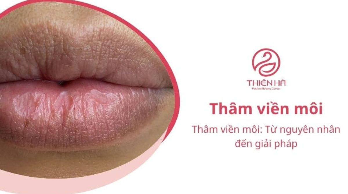 Thâm viền môi: Từ nguyên nhân đến giải pháp