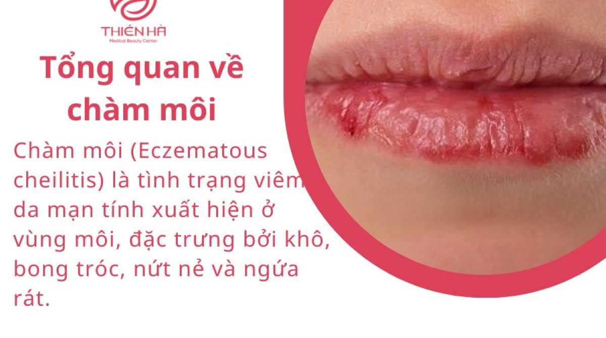 Top 7 thuốc bôi chàm môi hiệu quả, an toàn được bác sĩ khuyên dùng