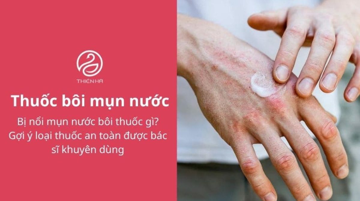 Thuốc bôi mụn nước nên dùng loại nào? Gợi ý 6 loại an toàn, bác sĩ khuyên dùng