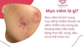 Thuốc trị mụn viêm loại bôi và uống: Giảm sưng đỏ, ngừa thâm & sẹo an toàn