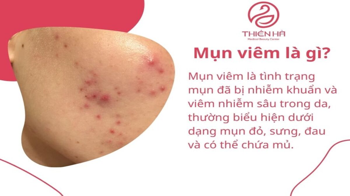 Thuốc trị mụn viêm loại bôi và uống: Giảm sưng đỏ, ngừa thâm & sẹo an toàn