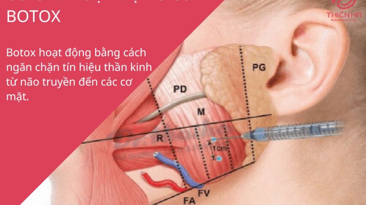 Tiêm Botox: Lợi ích, Quy trình & Lưu ý Quan Trọng Tại TMV Thiên Hà