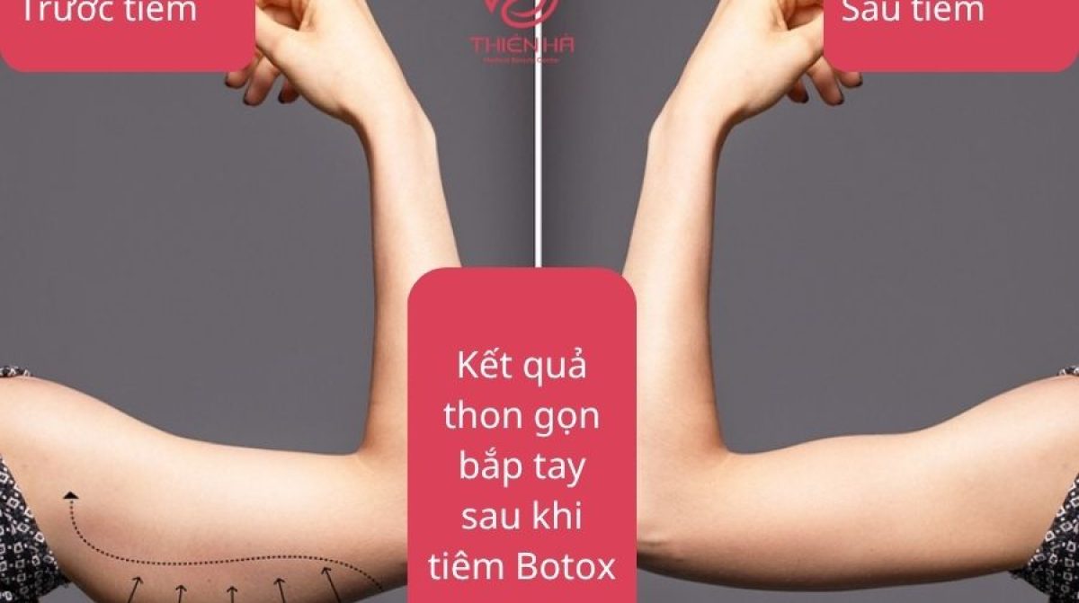 Tiêm Botox bắp tay: Thon gọn, săn chắc và quyến rũ hơn | TMV Thiên Hà