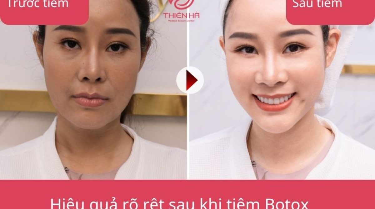 Tiêm Botox có hại không? Lợi ích và tác hại của Botox | TMV Thiên Hà