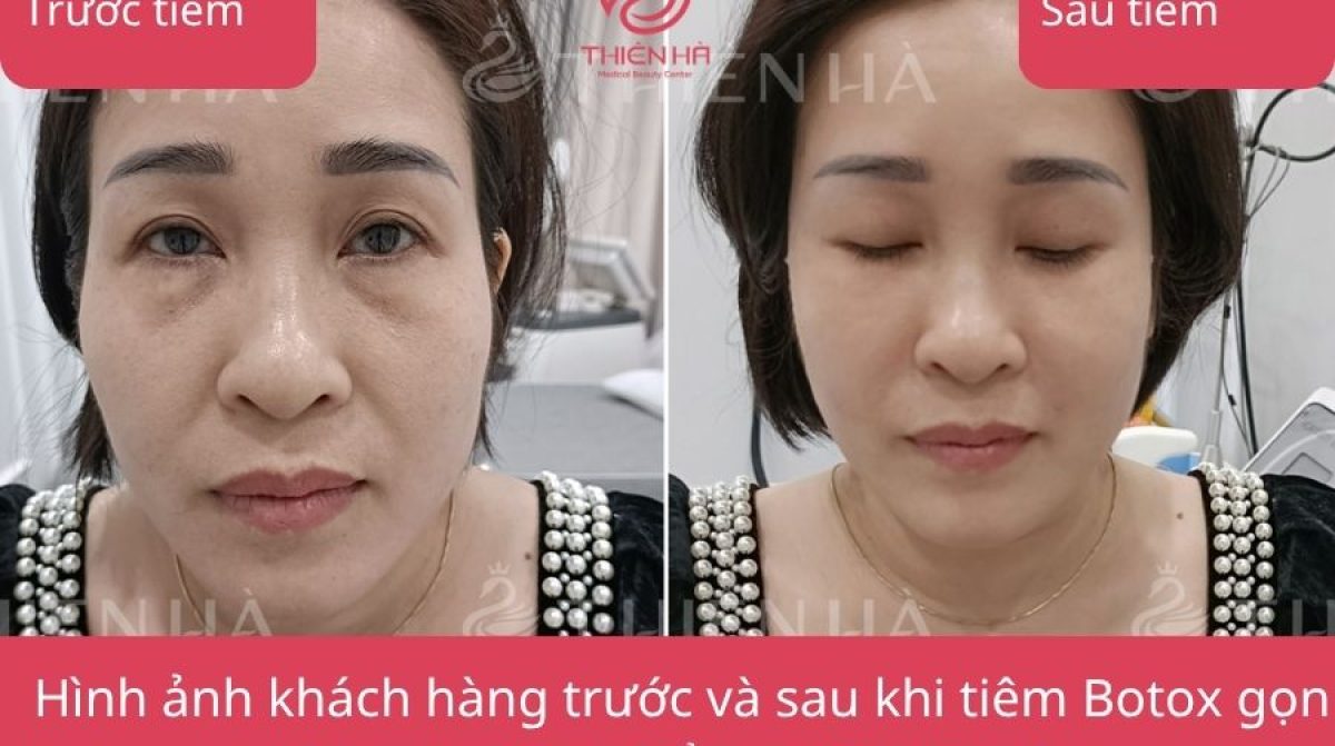 Tiêm Botox gọn hàm giá bao nhiêu tại Hà Nội | Viện thẩm mỹ Thiên Hà