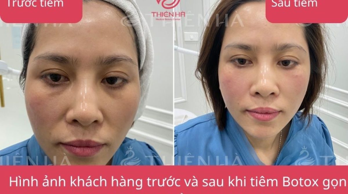 Tiêm Botox gọn hàm kiêng gì? 15+ điều CẦN TRÁNH sau tiêm