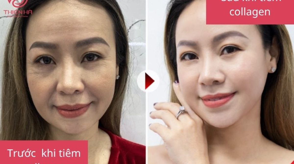 Tiêm Collagen: Lợi Ích, Rủi Ro & Quy Trình An Toàn Tại TMV Thiên Hà