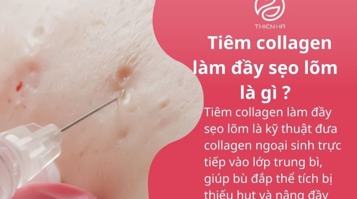Tiêm collagen làm đầy sẹo lõm: hiệu quả nhanh, an toàn, kéo dài