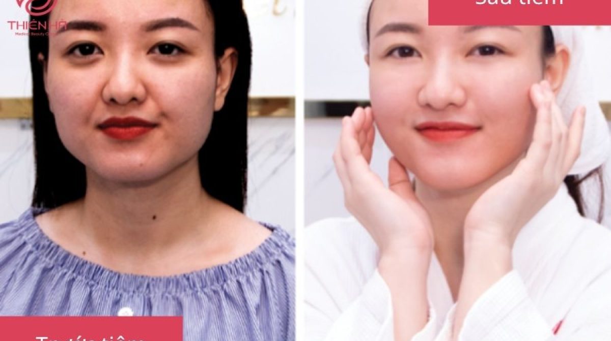 Tiêm Filler Mặt: Lợi Ích, Quy Trình, Chi Phí & Lưu Ý