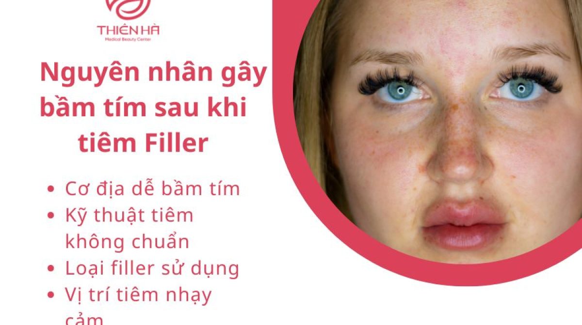 Tiêm Filler Bị Bầm: Nguyên Nhân, Cách Xử Lý và Phòng Ngừa Hiệu Quả | TMV Thiên Hà