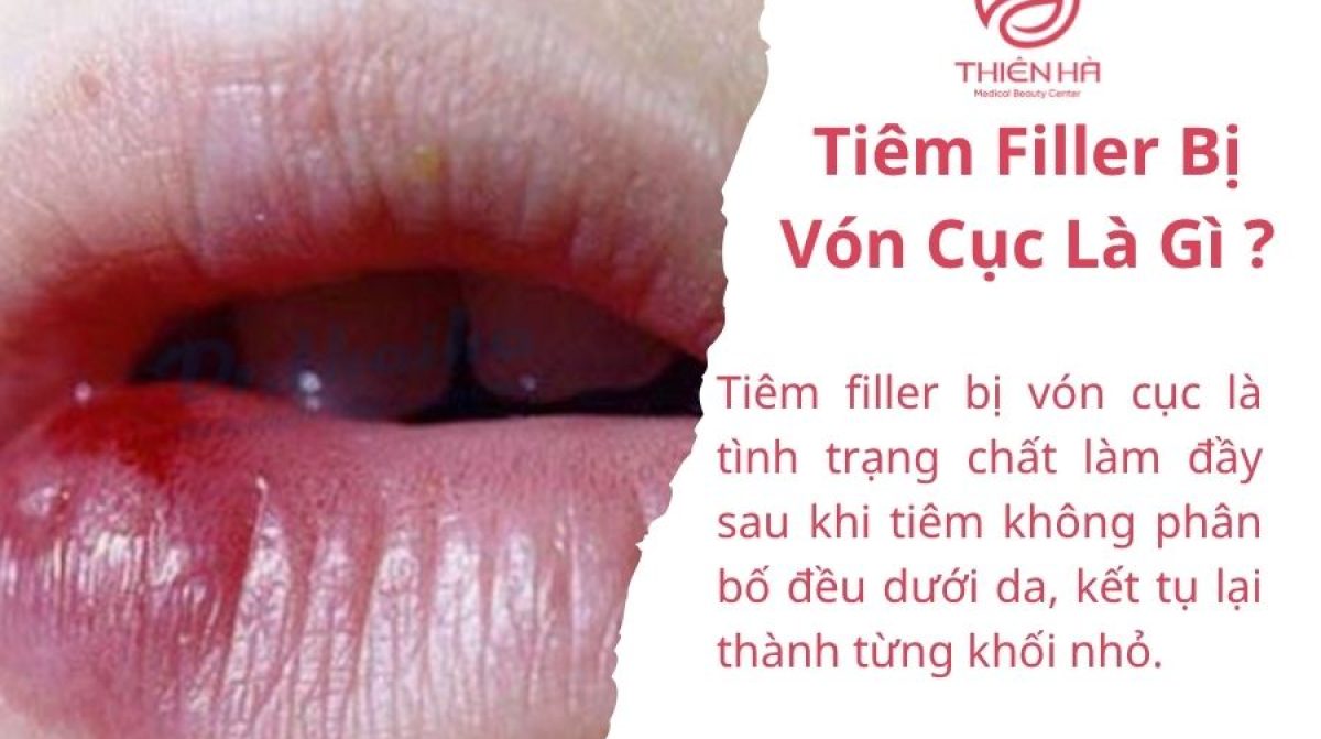 Tiêm Filler Bị Vón Cục: Nguyên Nhân, Cách Khắc Phục & Phòng Ngừa Hiệu Quả