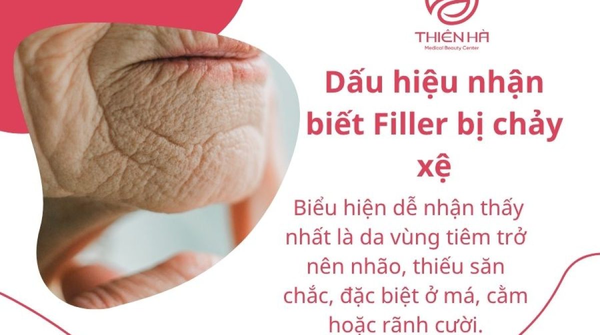 Tiêm Filler Có Bị Chảy Xệ Không? Chuyên Gia Giải Đáp