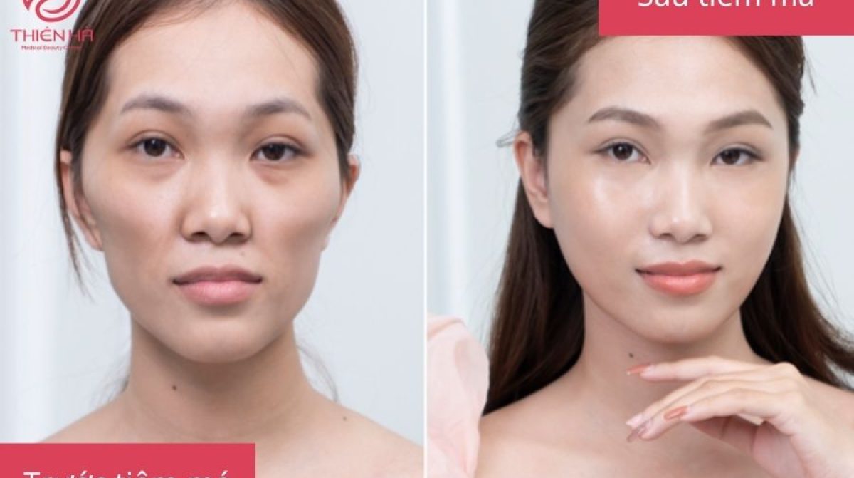 Tiêm Filler Má Baby: Lợi Ích, Quy Trình & Lưu Ý Quan Trọng Tại Thiên Hà Spa