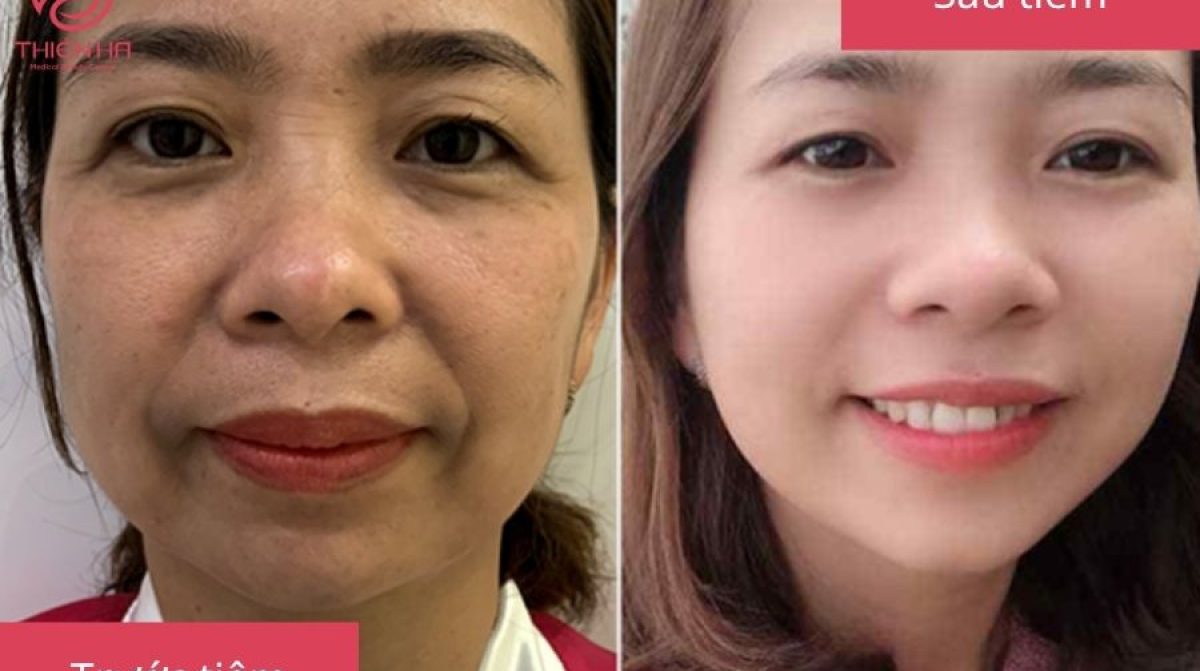 Tiêm Filler Mắt: Giải Pháp Trẻ Hóa Vùng Mắt Toàn Diện Tại Viện Thẩm Mỹ Thiên Hà