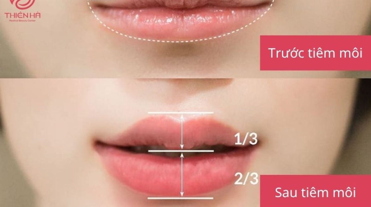 Tiêm Filler Môi: Mọi Điều Bạn Cần Biết | Viện Thẩm Mỹ Thiên Hà