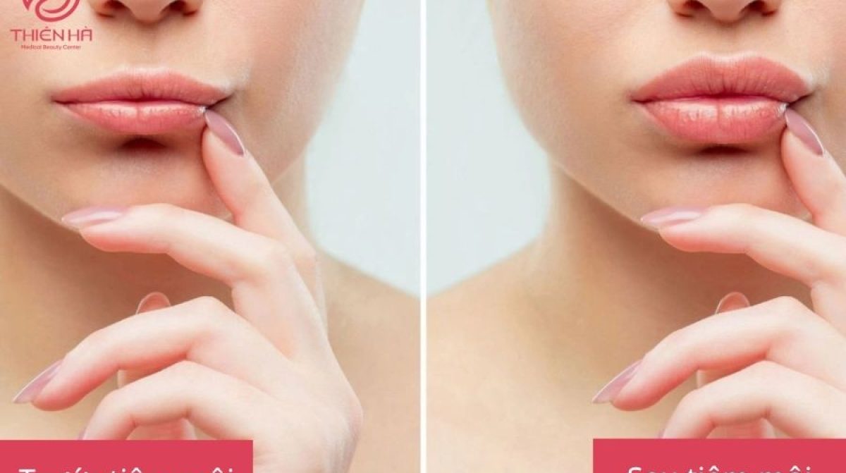 Tiêm Filler Môi Có Ảnh Hưởng Gì Không? Lợi Ích & Rủi Ro Cần Biết