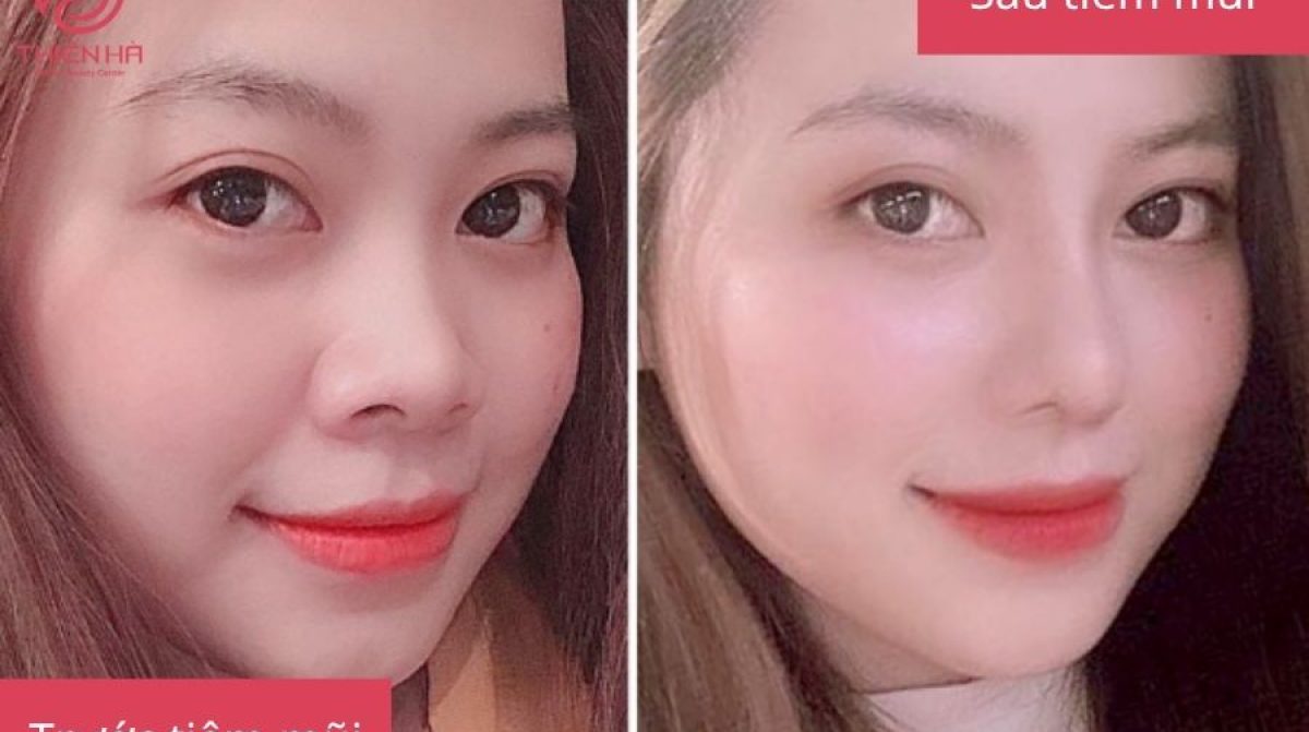 Tiêm Filler Mũi: Lợi Ích, Quy Trình & Lưu Ý Quan Trọng | TMV Thiên Hà