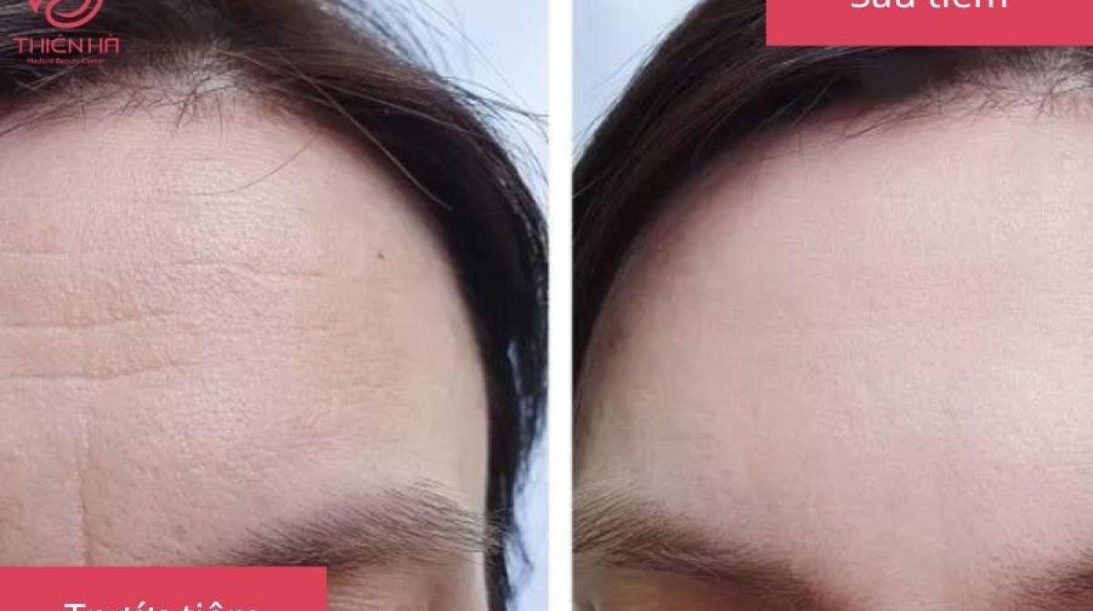 Tiêm Filler Trán: Lợi Ích, Quy Trình & Lưu Ý Tại Viện Thẩm Mỹ Thiên Hà
