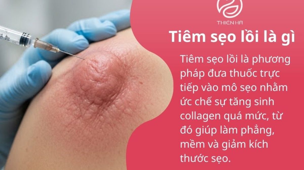 Tiêm sẹo lồi: Giải pháp xẹp sẹo nhanh, an toàn và hiệu quả
