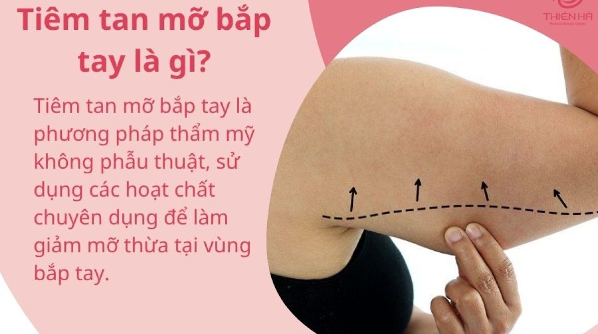 Tiêm tan mỡ bắp tay: Giải pháp thon gọn không cần phẫu thuật