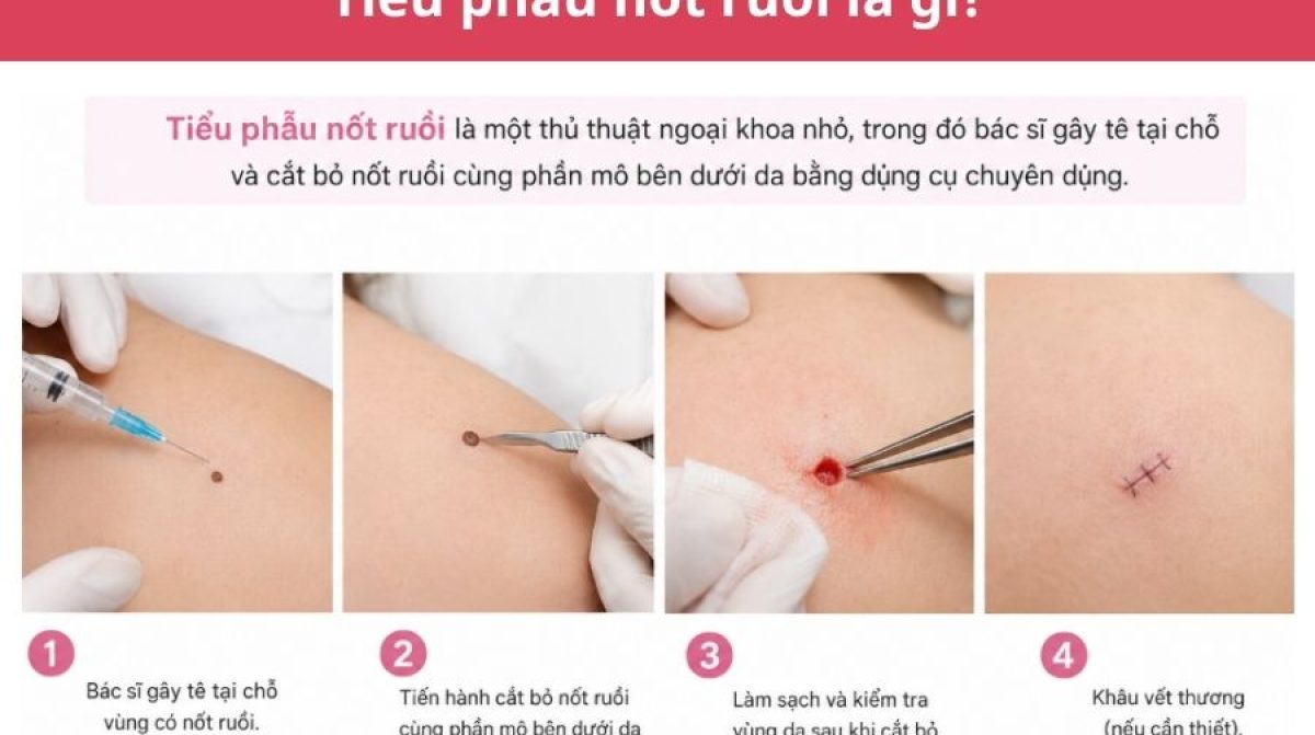 Tiểu phẫu nốt ruồi là gì? Quy trình, chi phí và cách chăm sóc