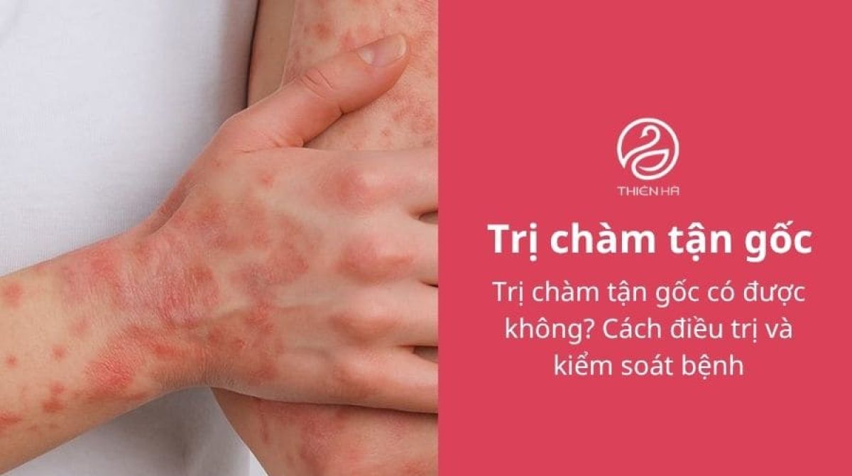 Trị chàm tận gốc có được không? Cách điều trị và kiểm soát bệnh