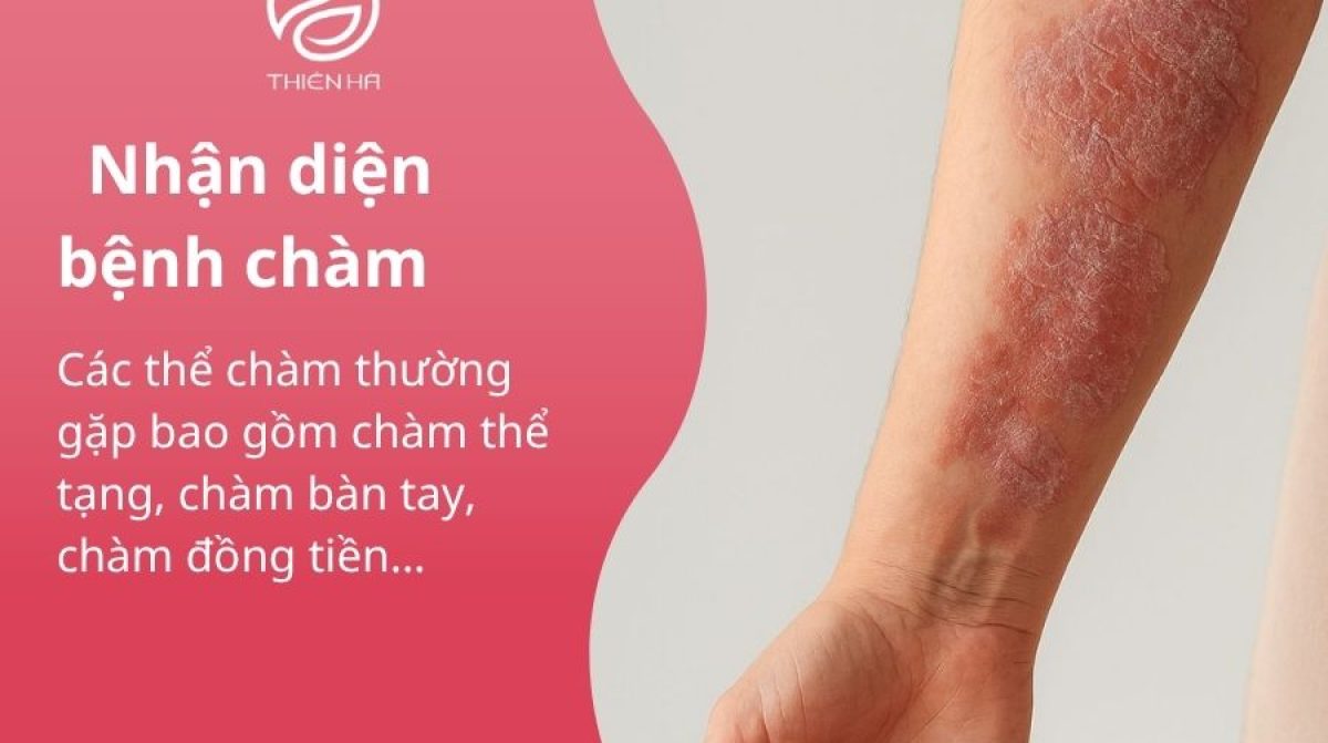 Trị chàm tận gốc uy tín và an toàn tại Viện Thẩm Mỹ Thiên Hà