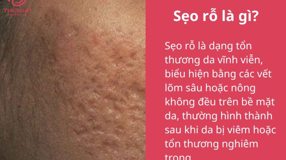 Trị sẹo rỗ bằng Laser: Hiệu quả, Quy trình & Chi phí tại TMV Thiên Hà