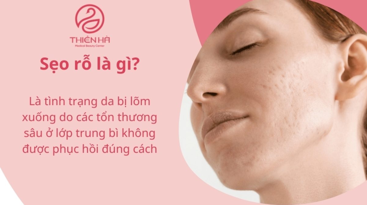 Trị sẹo rỗ bằng phương pháp Meso: Hiệu quả & quy trình 