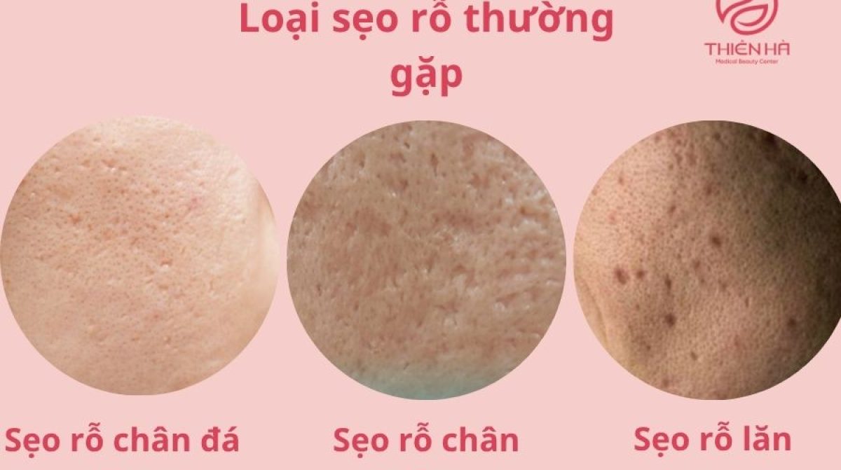 Trị sẹo rỗ bao nhiêu tiền? Bảng giá chi tiết các phương pháp
