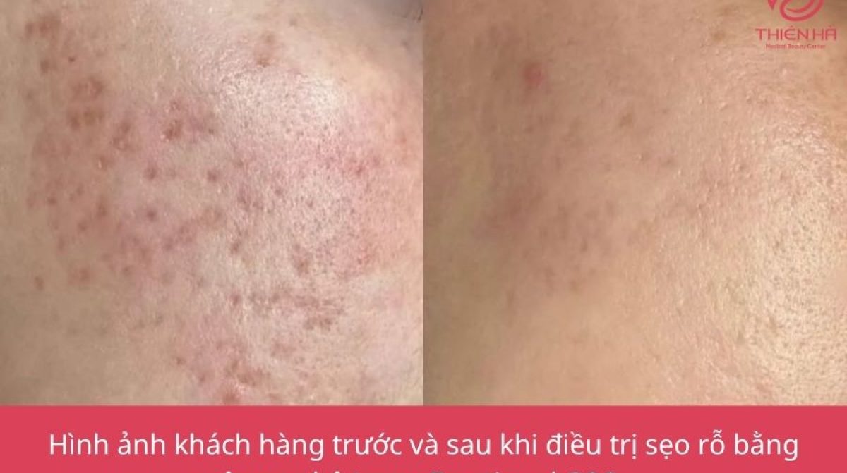 Trị sẹo rỗ lâu năm: Giải pháp hiệu quả và an toàn tại Viện thẩm mỹ Thiên Hà