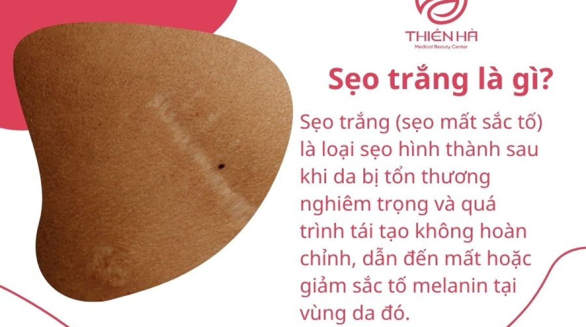 Trị sẹo trắng hiệu quả: Nguyên nhân, cách điều trị và phòng ngừa