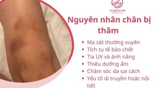 Trị thâm chân hiệu quả: Phương pháp tự nhiên và công nghệ hiện đại