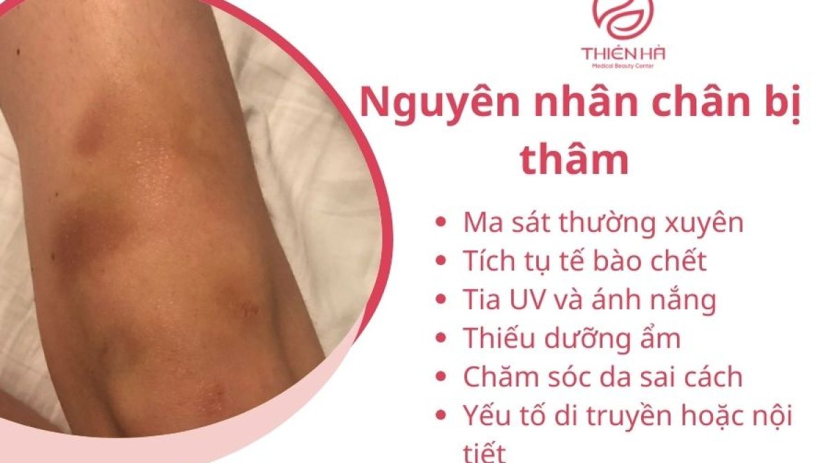 Trị thâm chân hiệu quả: Phương pháp tự nhiên và công nghệ hiện đại
