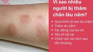 Cách trị thâm chân lâu năm hiệu quả nhanh bằng phương pháp chuyên sâu
