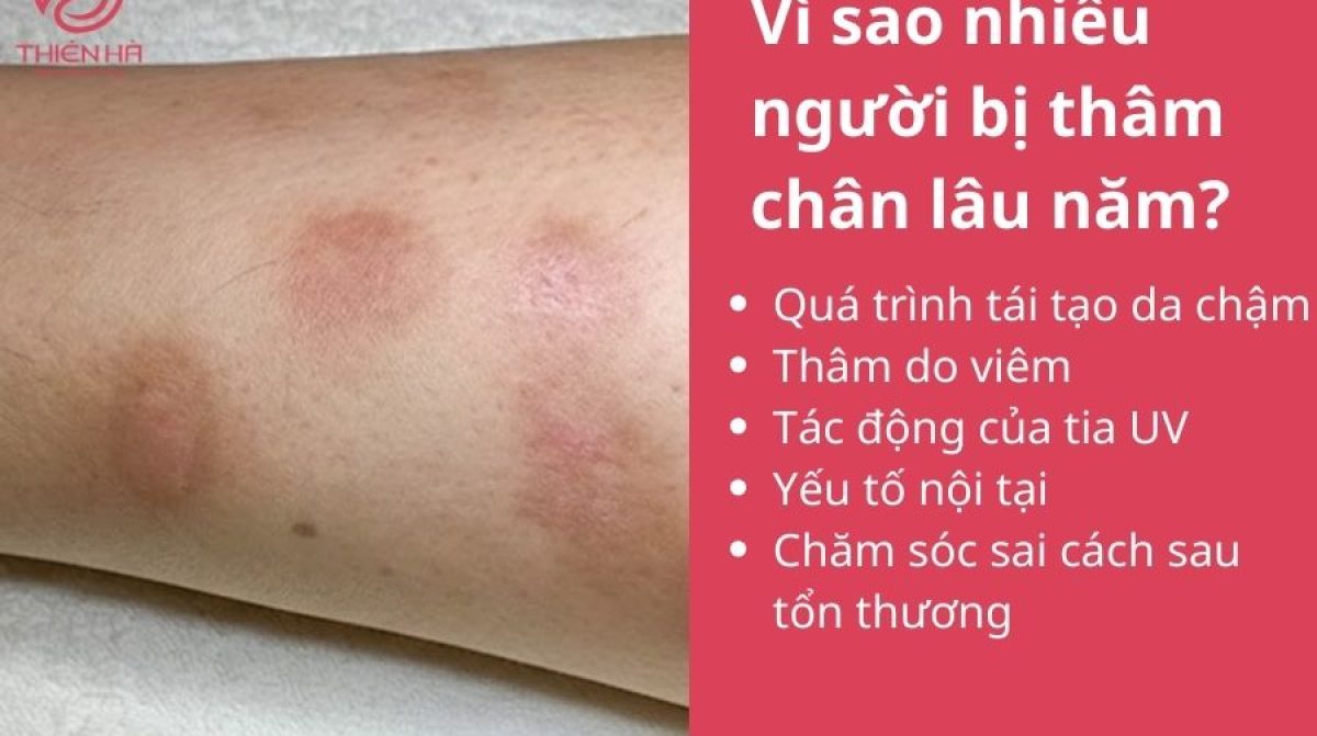 Cách trị thâm chân lâu năm hiệu quả nhanh bằng phương pháp chuyên sâu