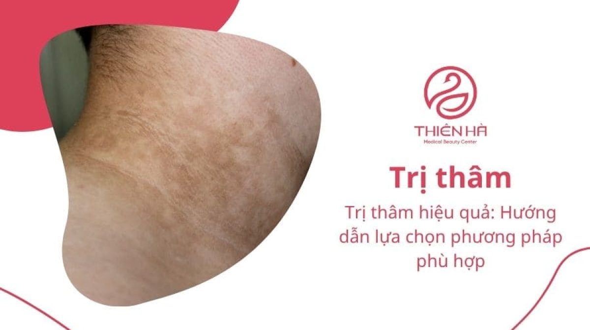 Trị thâm da hiệu quả: Hướng dẫn lựa chọn phương pháp phù hợp
