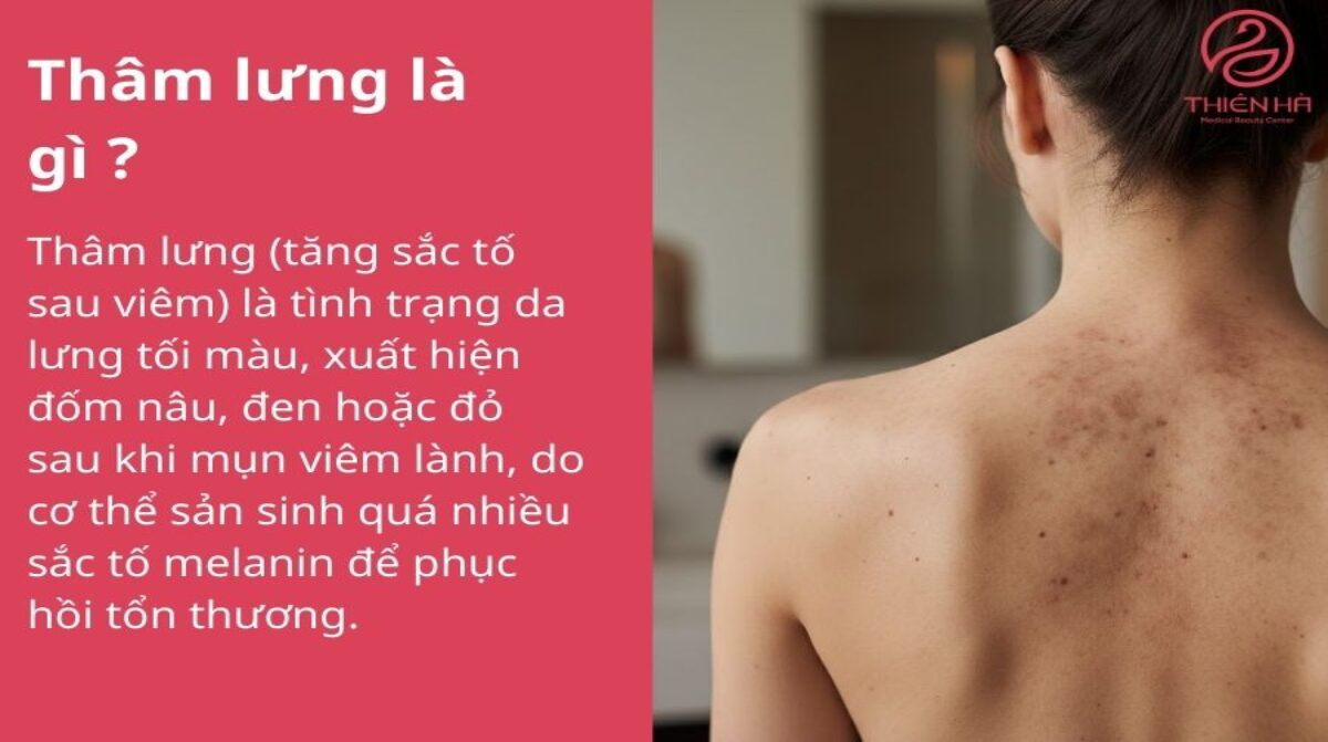 Trị thâm lưng hiệu quả, an toàn từ nguyên nhân đến giải pháp