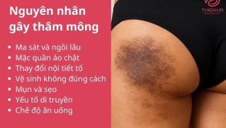 Bật mí cách trị thâm mông nhanh hiệu quả được chuyên gia khuyên dùng