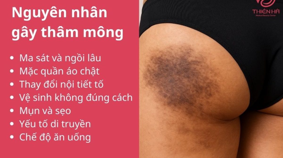 Bật mí cách trị thâm mông nhanh hiệu quả được chuyên gia khuyên dùng