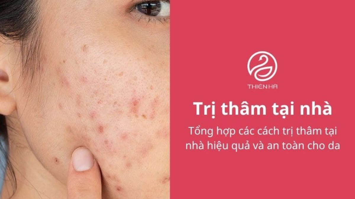 Tổng hợp các cách trị thâm tại nhà hiệu quả và an toàn cho da