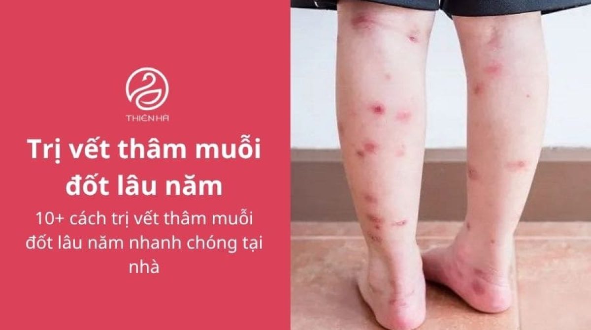 10+ cách trị vết thâm muỗi đốt lâu năm nhanh chóng tại nhà