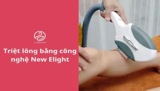 Triệt lông bằng công nghệ New Elight