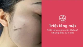 Triệt lông mặt có tốt không? Những điều cần biết