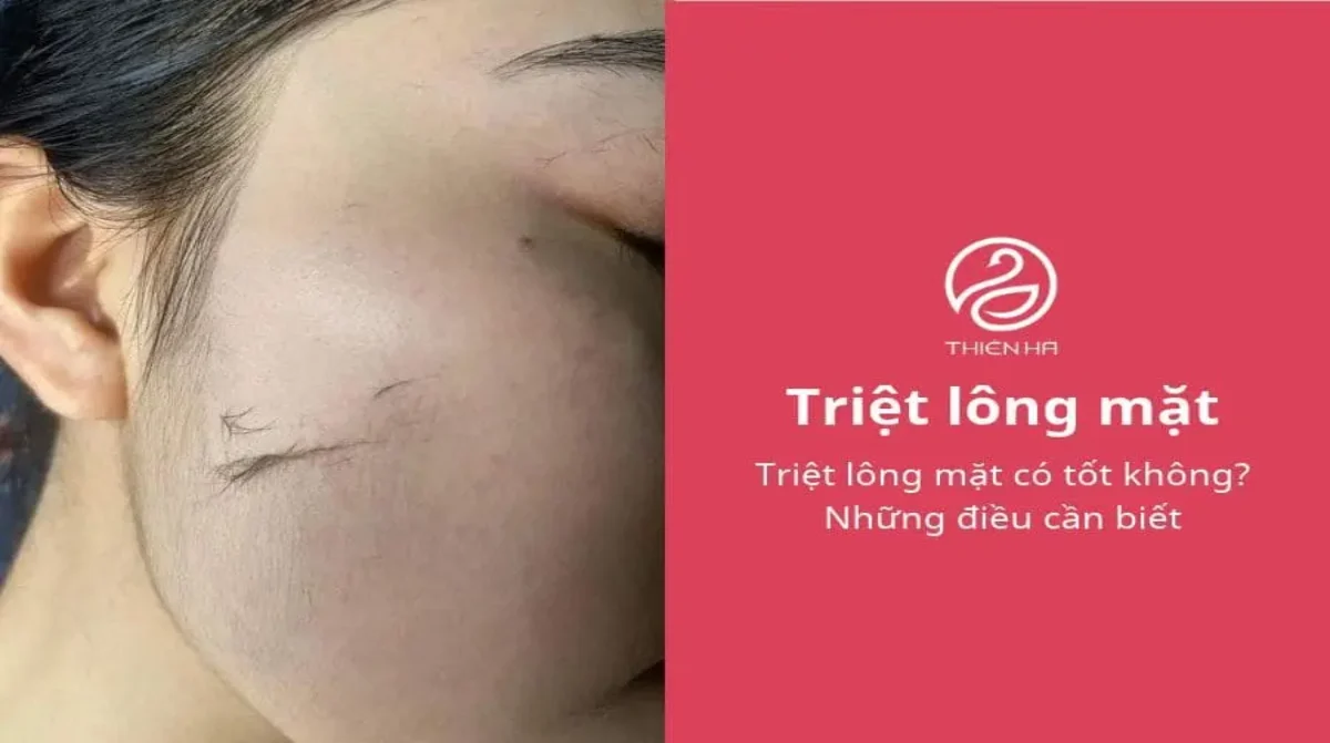 Triệt lông mặt có tốt không? Những điều cần biết