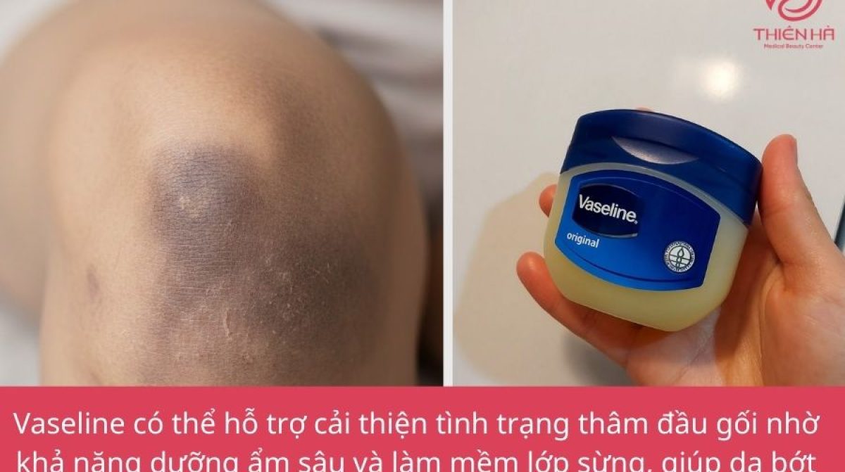 Giải đáp: Vaseline có trị thâm đầu gối không và cách sử dụng đúng