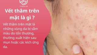 Vết thâm trên mặt: Nguyên nhân và cách làm mờ hiệu quả, an toàn