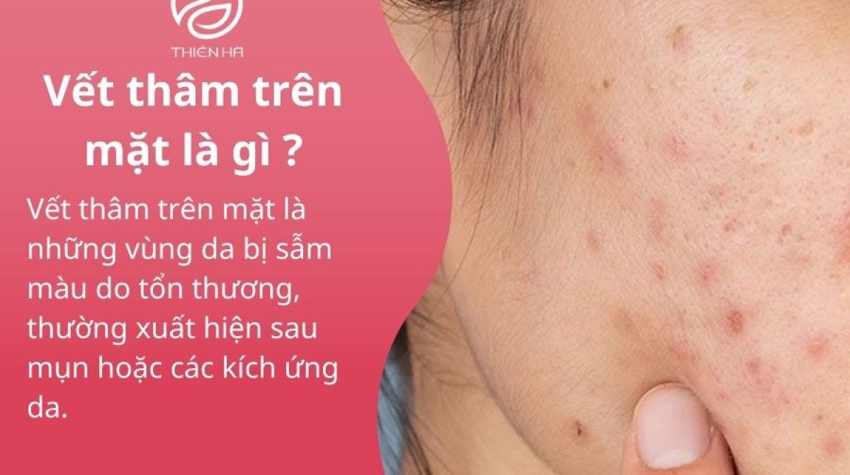 Vết thâm trên mặt: Nguyên nhân và cách làm mờ hiệu quả, an toàn